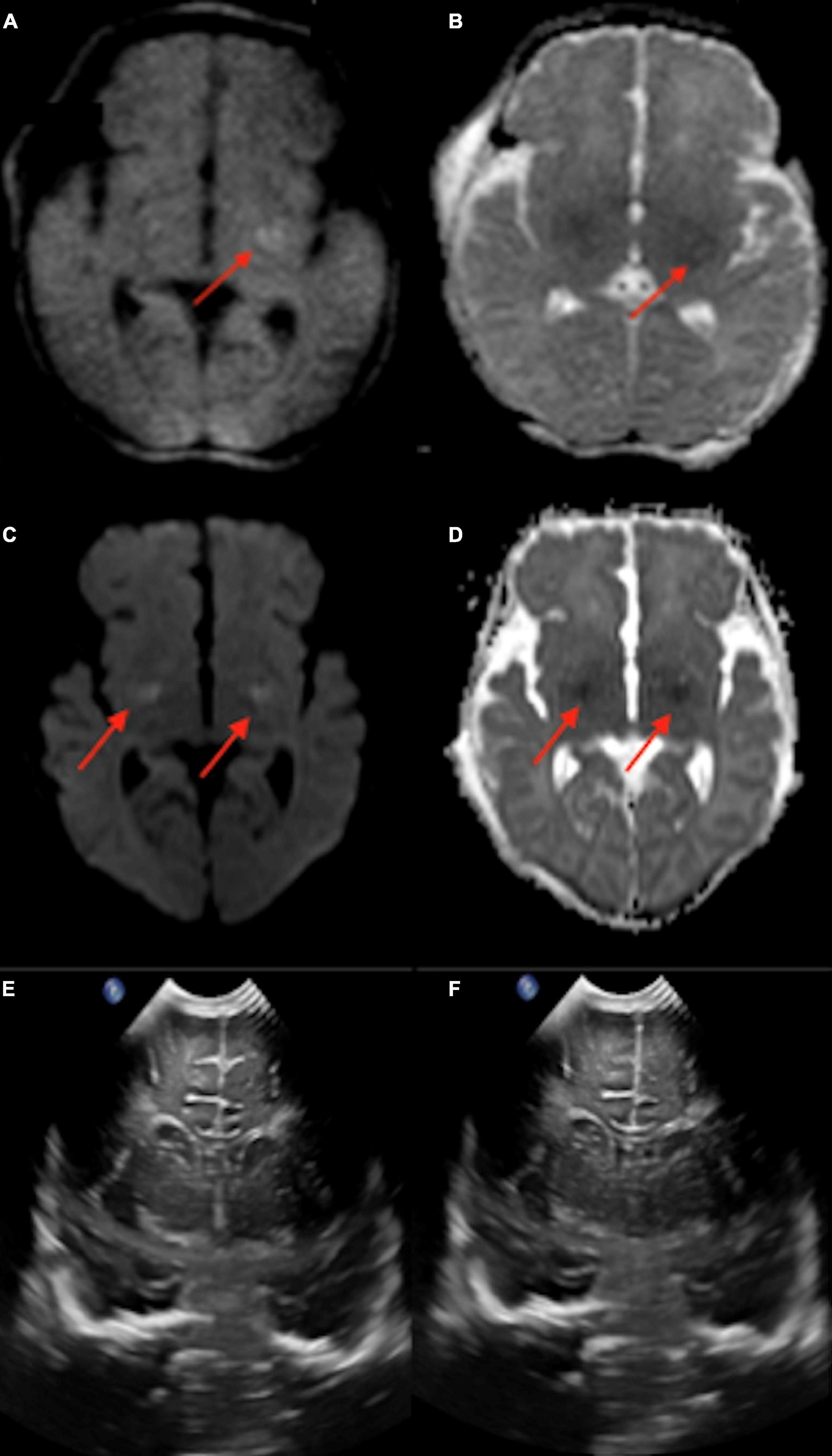 A 1-Tesla MRI system for dedicated brain imaging in the neonatal intensive care unit